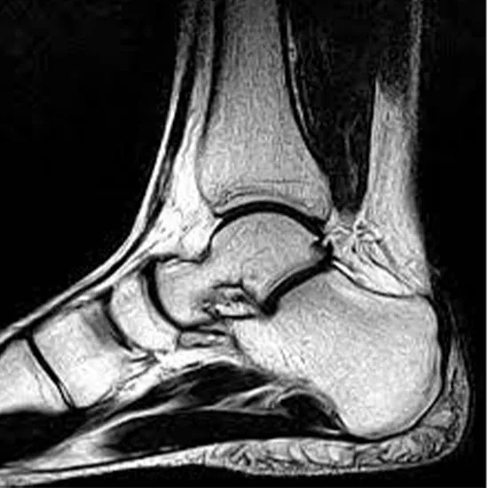 MRI Screening Of Ankle Joint